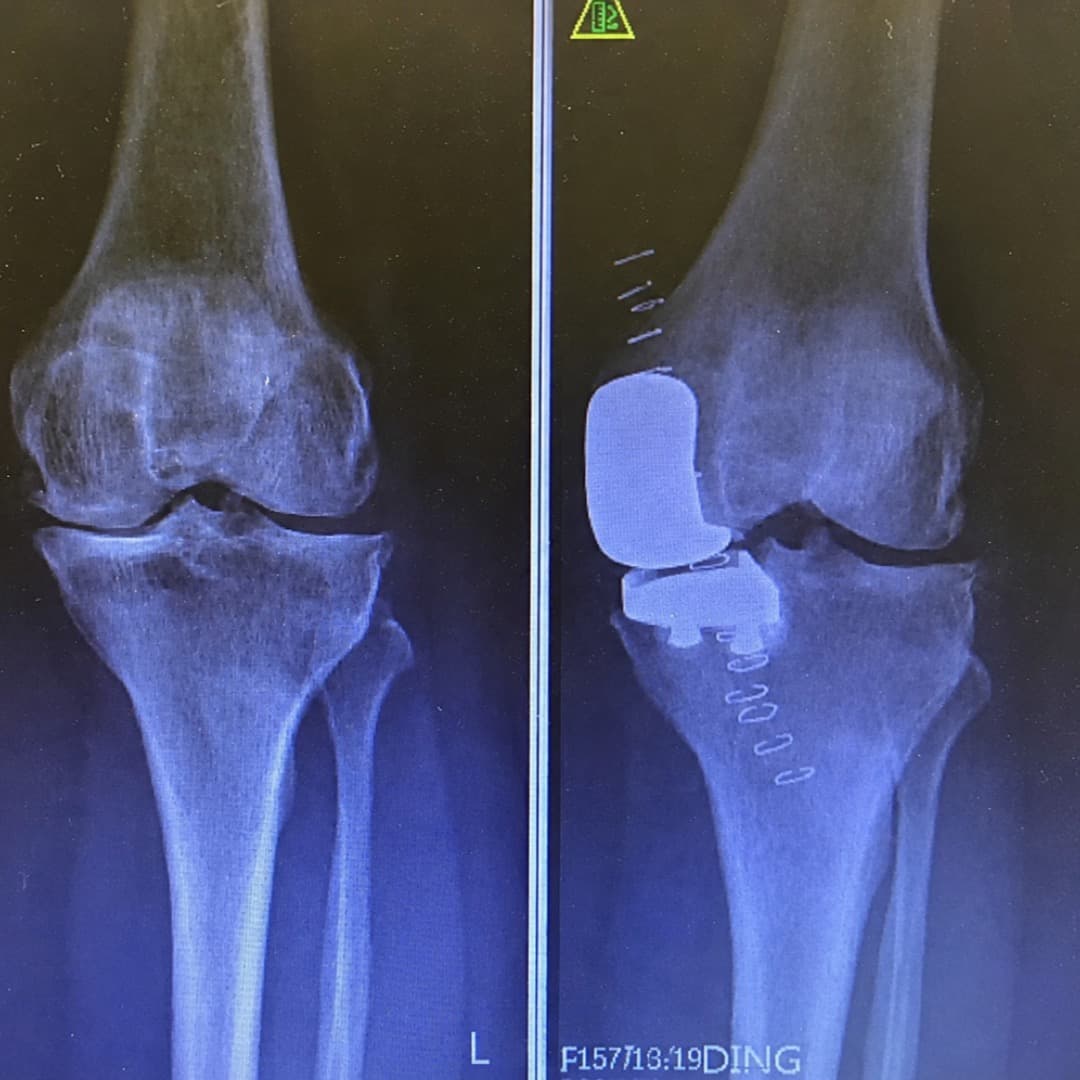 Dr Mujahid Jamil Khattak hip and knee surgery — practice highlight 4