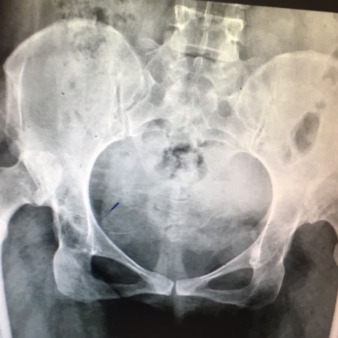 Dr Mujahid Jamil Khattak hip and knee surgery — practice highlight 5