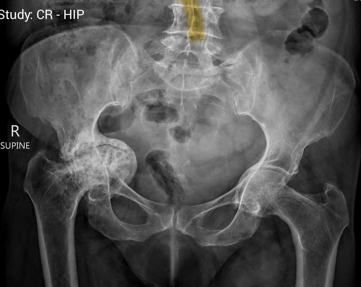 Dr Mujahid Jamil Khattak hip and knee surgery — practice highlight 1a