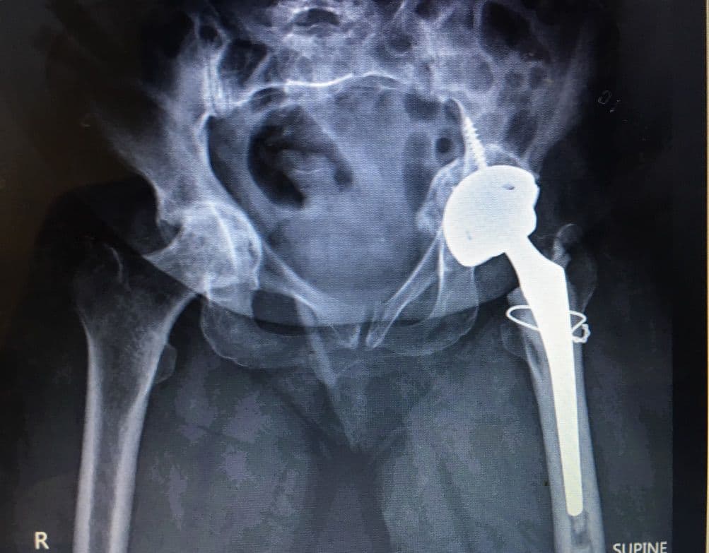 Dr Mujahid Jamil Khattak hip and knee surgery — practice highlight 2a