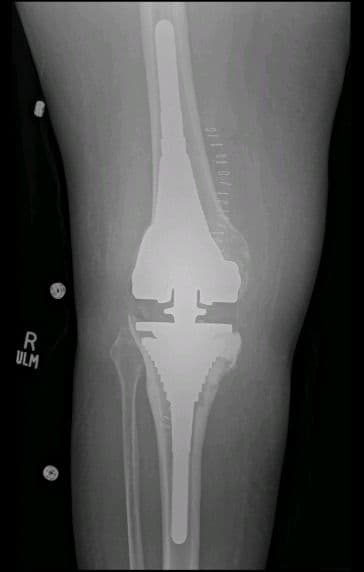 Dr Mujahid Jamil Khattak hip and knee surgery — practice highlight 3a