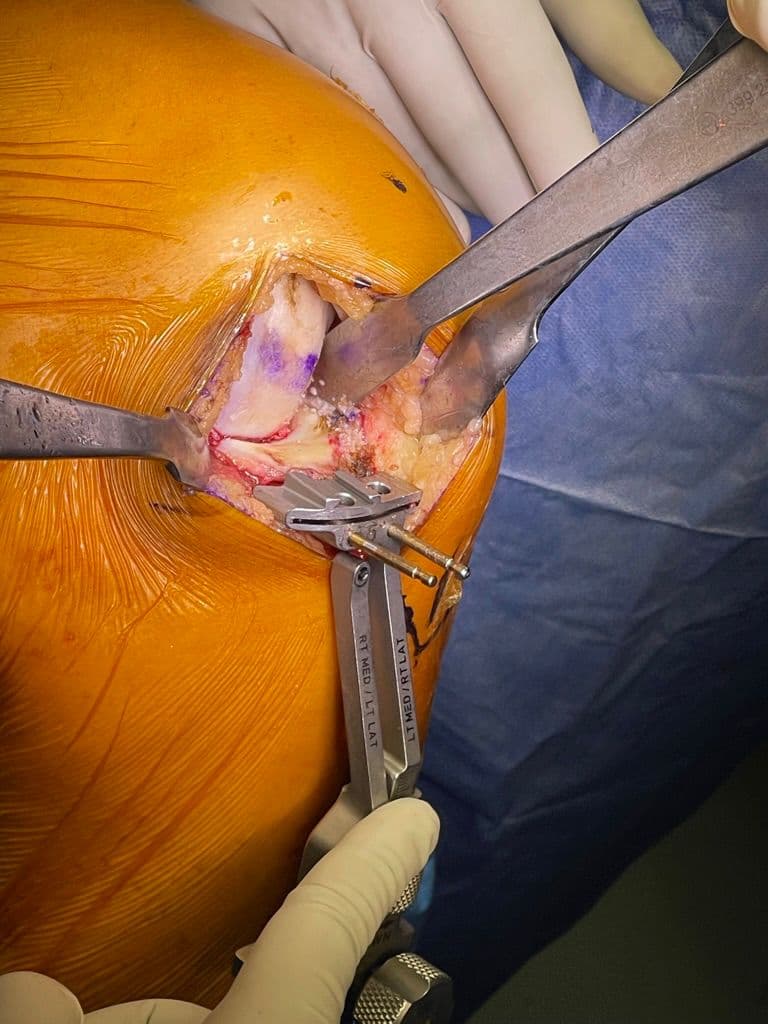 Dr Mujahid Jamil Khattak hip and knee surgery — practice highlight 4a