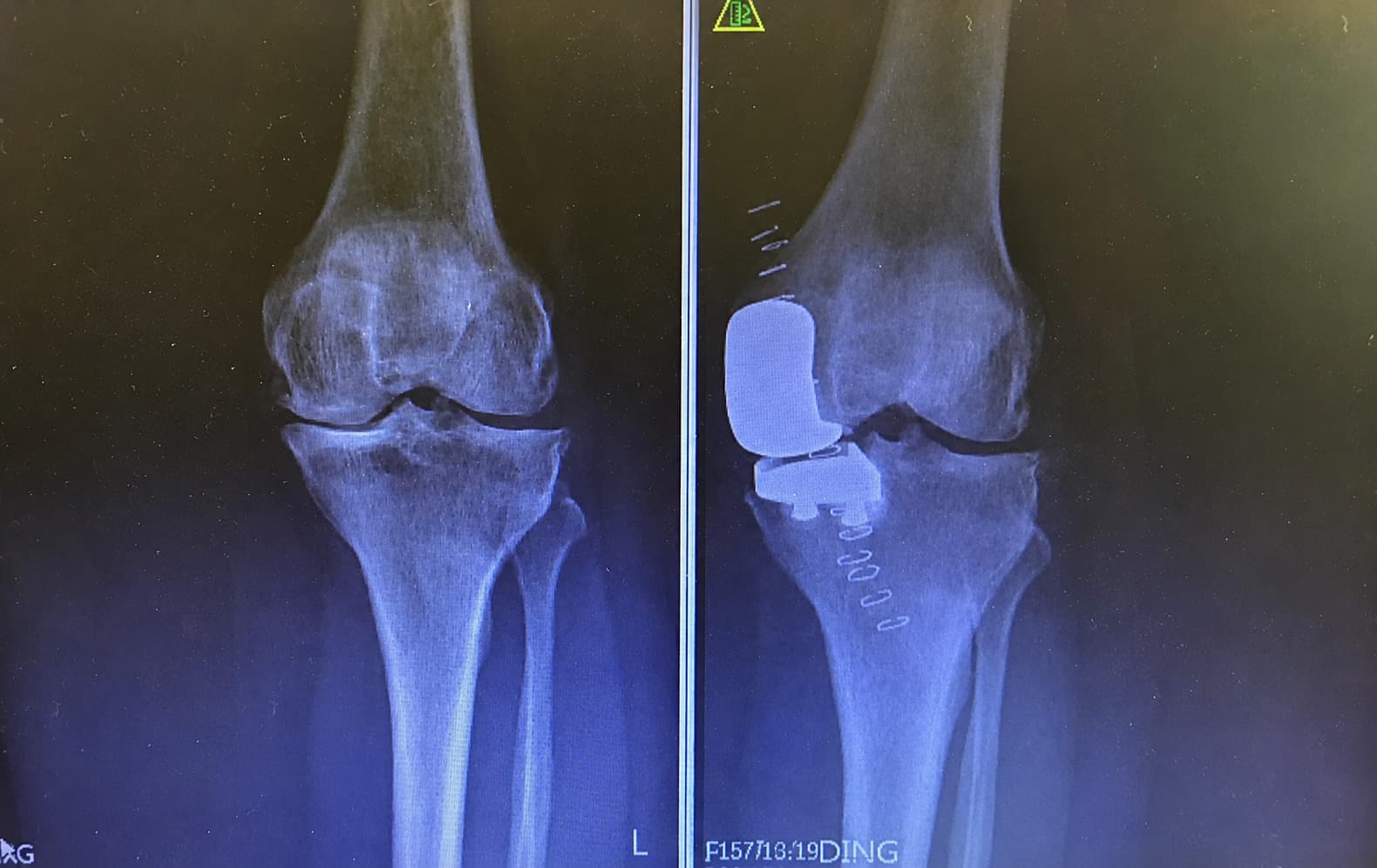Dr Mujahid Jamil Khattak hip and knee surgery — practice highlight 4b