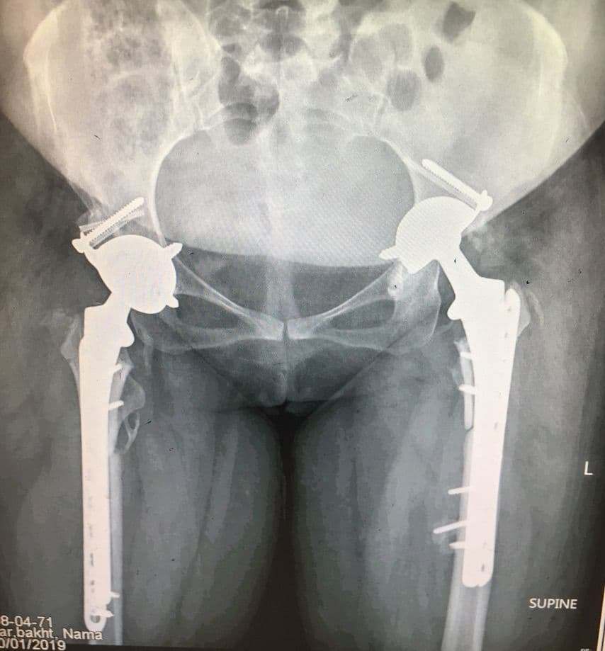 Dr Mujahid Jamil Khattak hip and knee surgery — practice highlight 5b